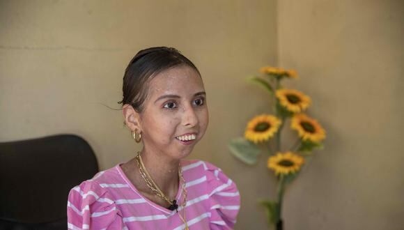 Nathaly Cerda, de 29 años, cuenta los cambios que ha dejado en su vida y en su cuerpo la esclerodermia sistémica. (Foto: Jorge Torres / EFE)