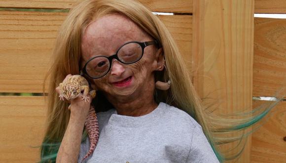 Adalia Rose Williams nació con progeria, también conocida como síndrome de Hutchinson-Gilford. (Foto: @adalia06).